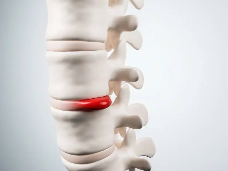 Disc Injury Treatment Near Me in Reading, PA. Chiropractor For Disc Injury Pain Relief.